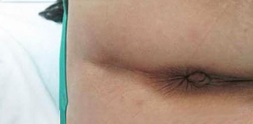 hình ảnh thịt thừa và da thừa ở hậu môn