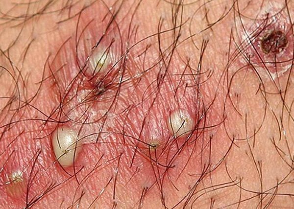 nổi mụn đầu trắng ở vùng kín ở nữ giới là bị gì
