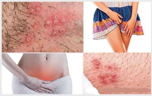 nổi mụn đầu trắng ở vùng kín nữ giới là bị gì