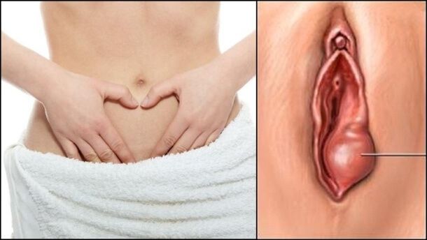 nổi hạch ở vùng kín nữ giới có sao không