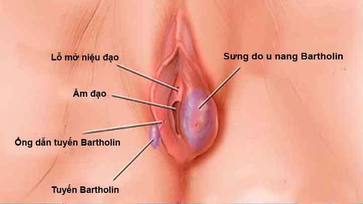 nổi hạch ở vùng kín nữ giới là bị gì