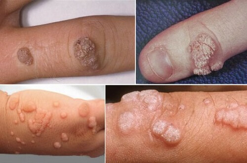 hình ảnh các bệnh xã hội thường gặp