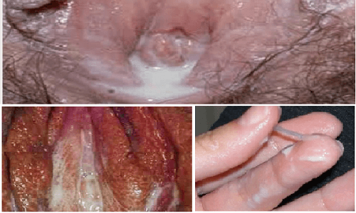 hình ảnh bệnh lậu ở từng giai đoạn
