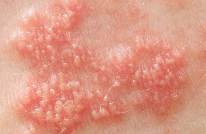 hình ảnh các bệnh xã hội thường gặp