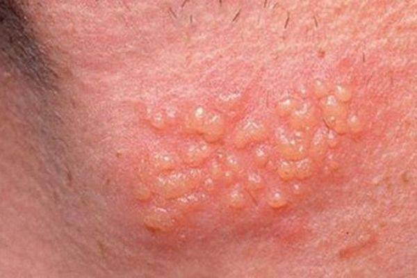 hình ảnh bệnh mụn rộp sinh dục