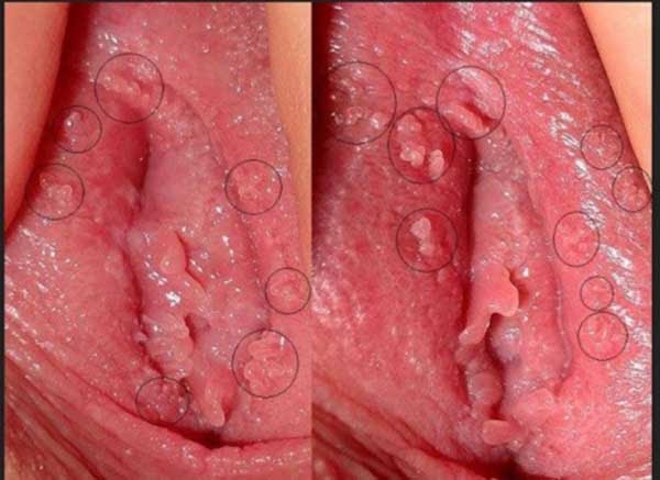 các bệnh dễ nhầm lẫn với sùi mào gà
