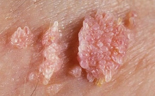 các bệnh dễ nhầm lẫn với bệnh sùi mào gà
