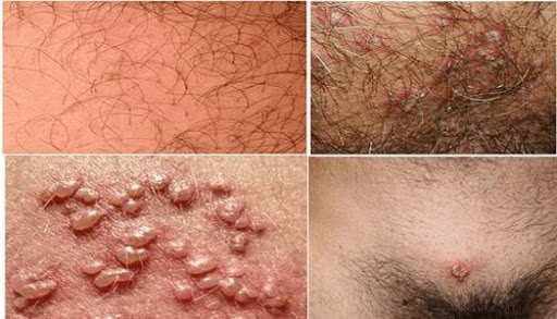 Ngứa môi lớn vùng kín sau khi quan hệ có sao không