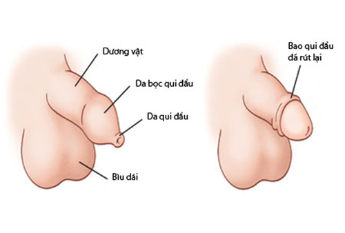 Thế nào là DÀI BAO QUY ĐẦU và HẸP BAO QUY ĐẦU