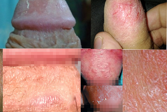 Thuốc trị nứt bao quy đầu
