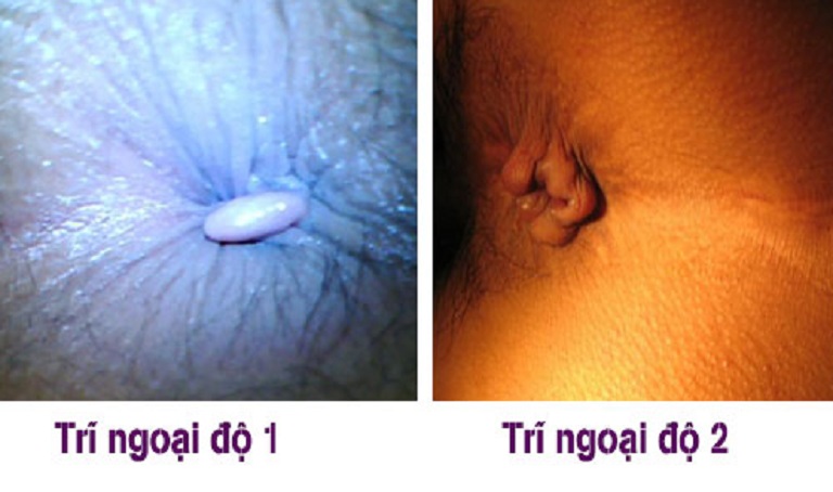 Búi trĩ lòi ra nhưng không đau