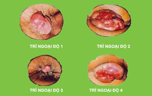 búi trĩ lòi ra nhưng không đau