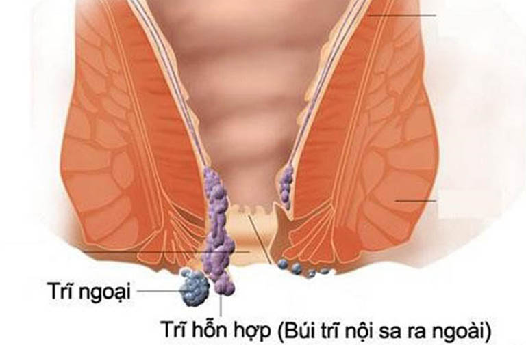 Cách nhét búi trĩ vào trong tại nhà hiệu quả