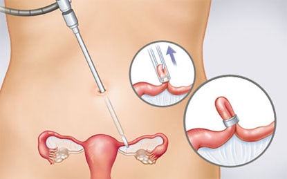 Cách đặt vòng tránh thai tại nhà như thế nào