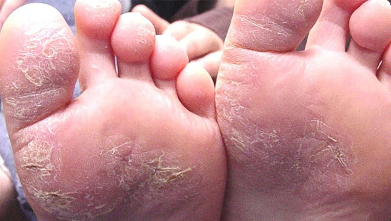 hình ảnh bệnh á sừng