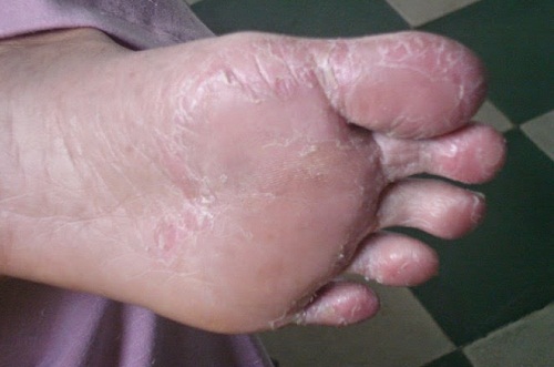 Hình ảnh bệnh á sừng