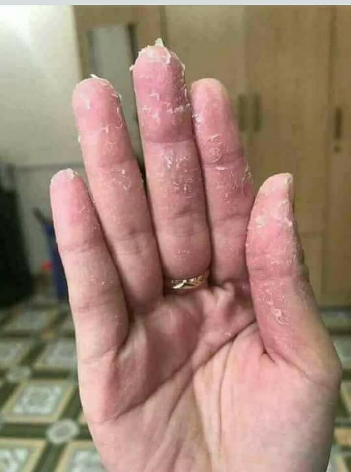 hình ảnh bệnh á sừng