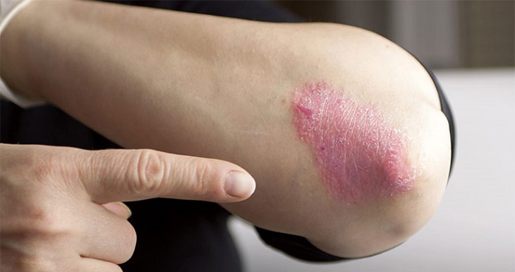 cách chữa bệnh vảy nến