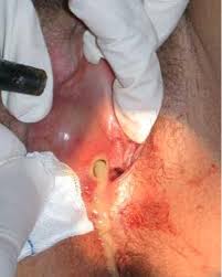 Viêm tuyến Bartholin bị vỡ mủ