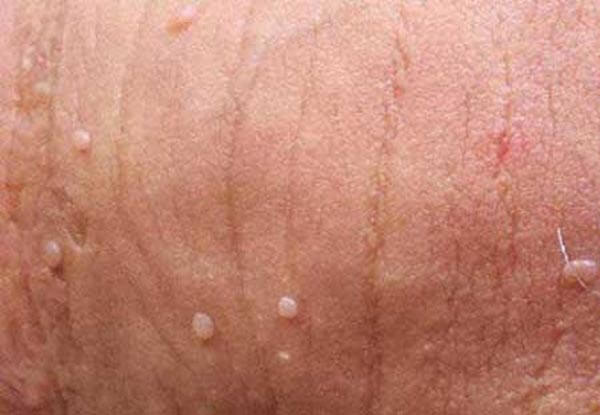 Nổi mụn thịt ở dương vật