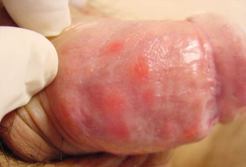 Nổi mụn thịt ở dương vật