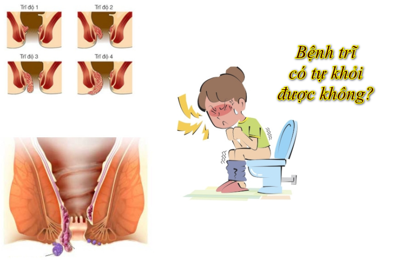 Chi phí cắt trĩ tầm bao nhiêu tiền năm 2020