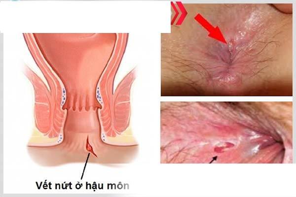 Hiện tượng hậu môn chảy nước vàng