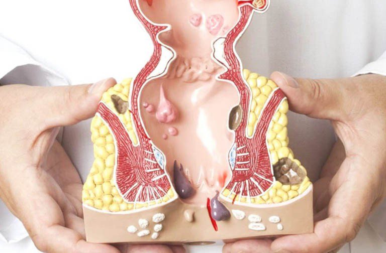 Hiện tượng hậu môn chảy nước vàng
