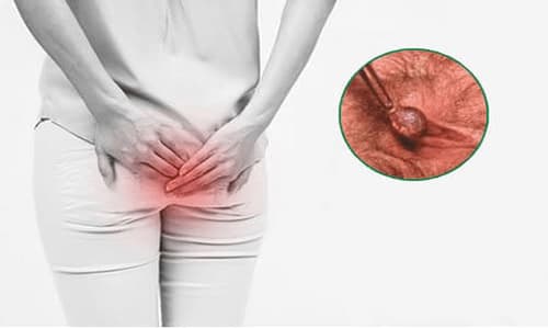 Tư vấn về bệnh trĩ onine miễn phí qua điện thoại