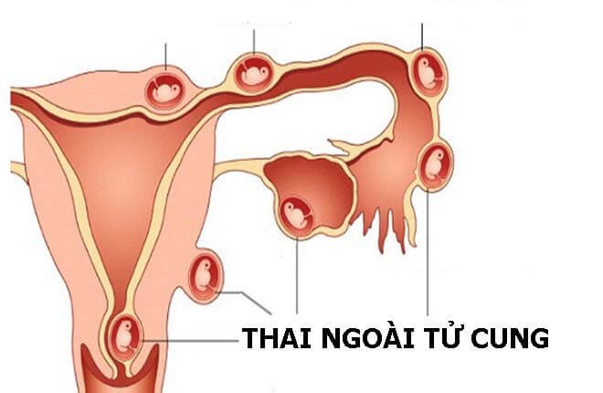 Thai vào tử cung muộn có sao không