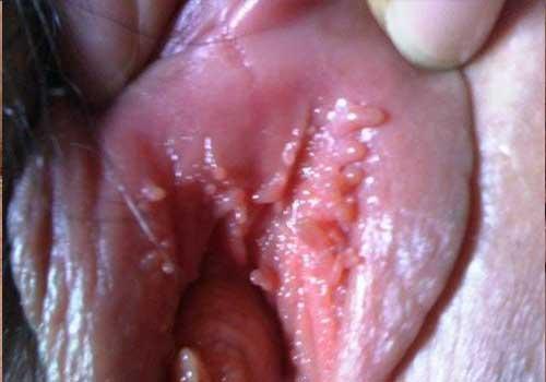 Nổi cục thịt thừa ở môi bé là bị gì