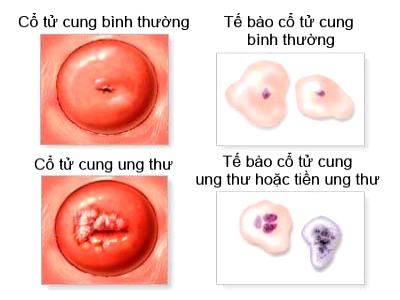 U nhú cổ tử cung có nguy hiểm không