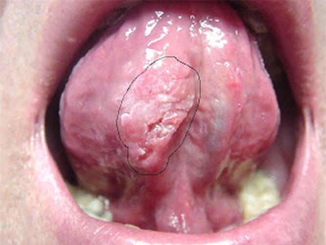 Cách chữa sùi mào gà ở miệng lưỡi