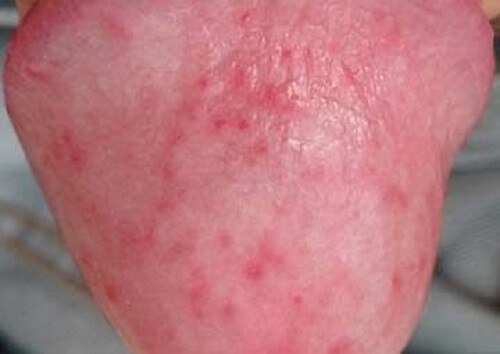 Cậu nhỏ nổi chấm đỏ là bị gì