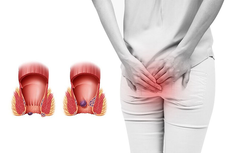 Top 10 thuốc bôi trĩ tốt nhất hiện nay