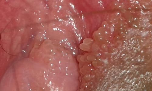 Chuỗi hạt ngọc âm vật triệu chứng và Cách điều trị tại nhà