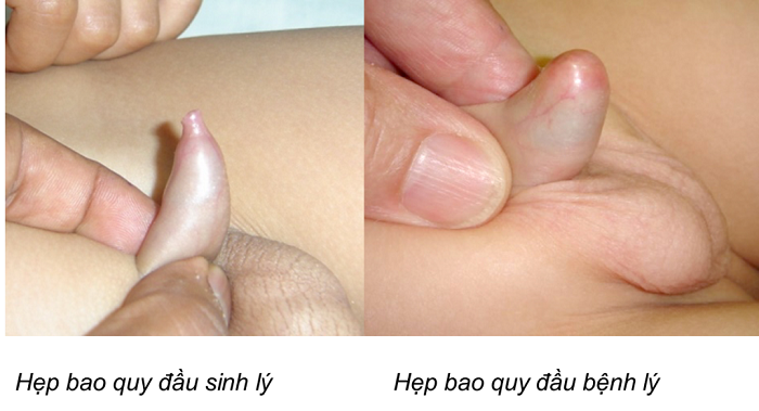 Cách kiểm tra hẹp bao quy đầu ở trẻ tại nhà