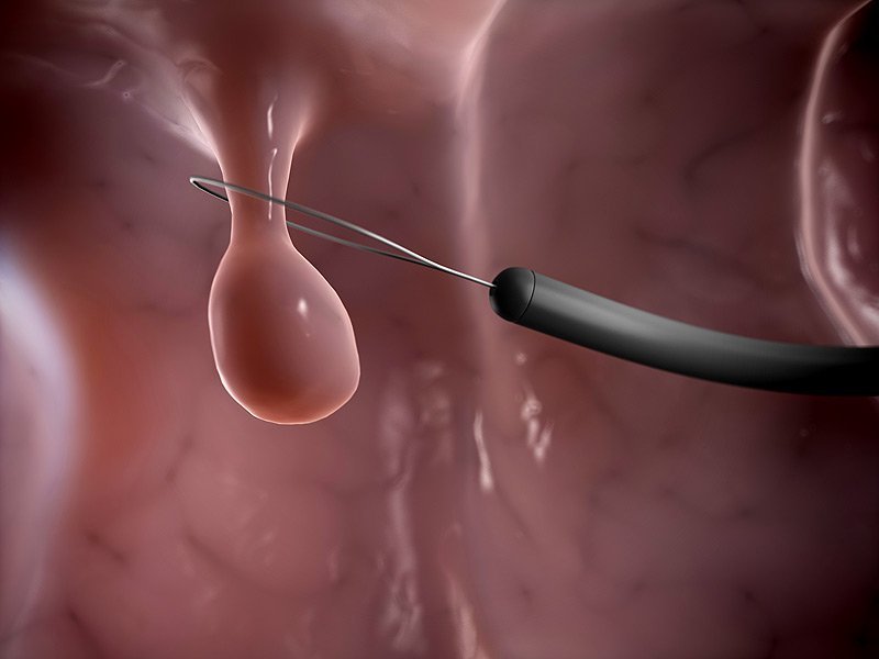 Chi phí mổ polyp buồng tử cung hết bao nhiêu tiền