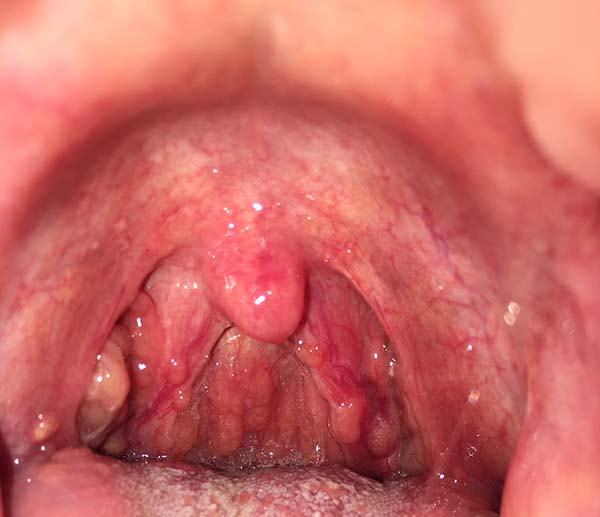 Hình ảnh viêm họng hạt ở trẻ em và người lớn chi tiết