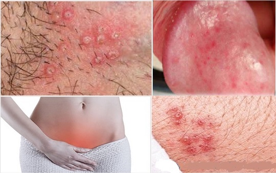 Bôi thuốc mỡ vào vùng kín trị bệnh gì và Cách bôi hiệu quả