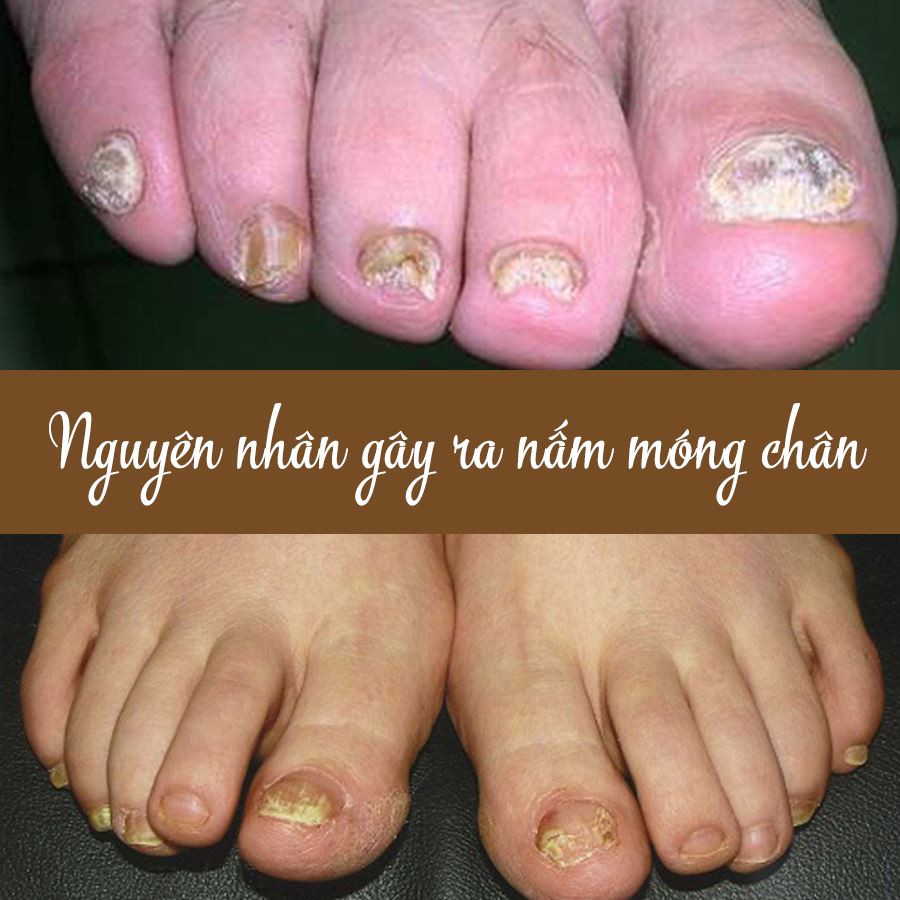 Nấm móng chân, Nguyên nhân, Hình ảnh, Cách chữa trị
