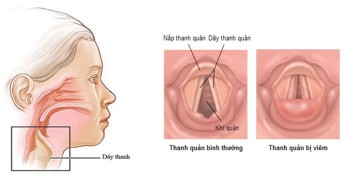 Đau họng lâu ngày có sao không