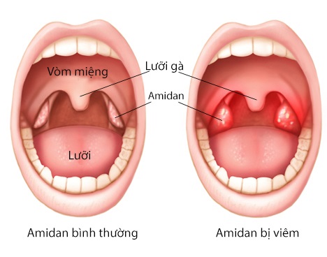 Đau họng lâu ngày có sao không