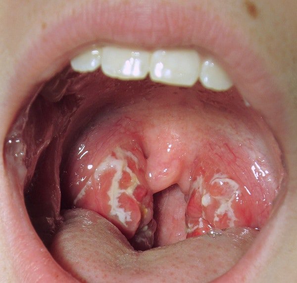 Đau họng có mủ là bệnh gì