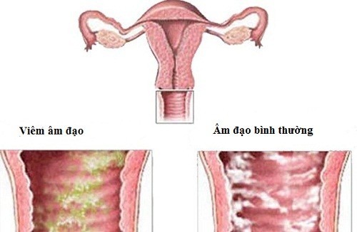 Vùng kín có mùi chua thường do viêm âm đạo