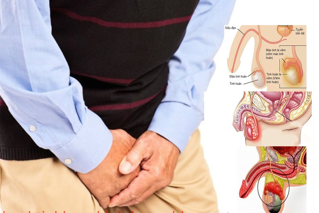 Viêm mào tinh hoàn có thể gây đau đớn