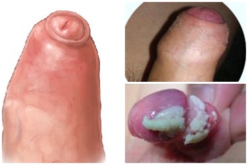Bựa sinh dục có nguy hiểm không