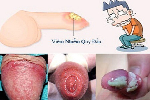 Bựa sinh dục có nguy hiểm không
