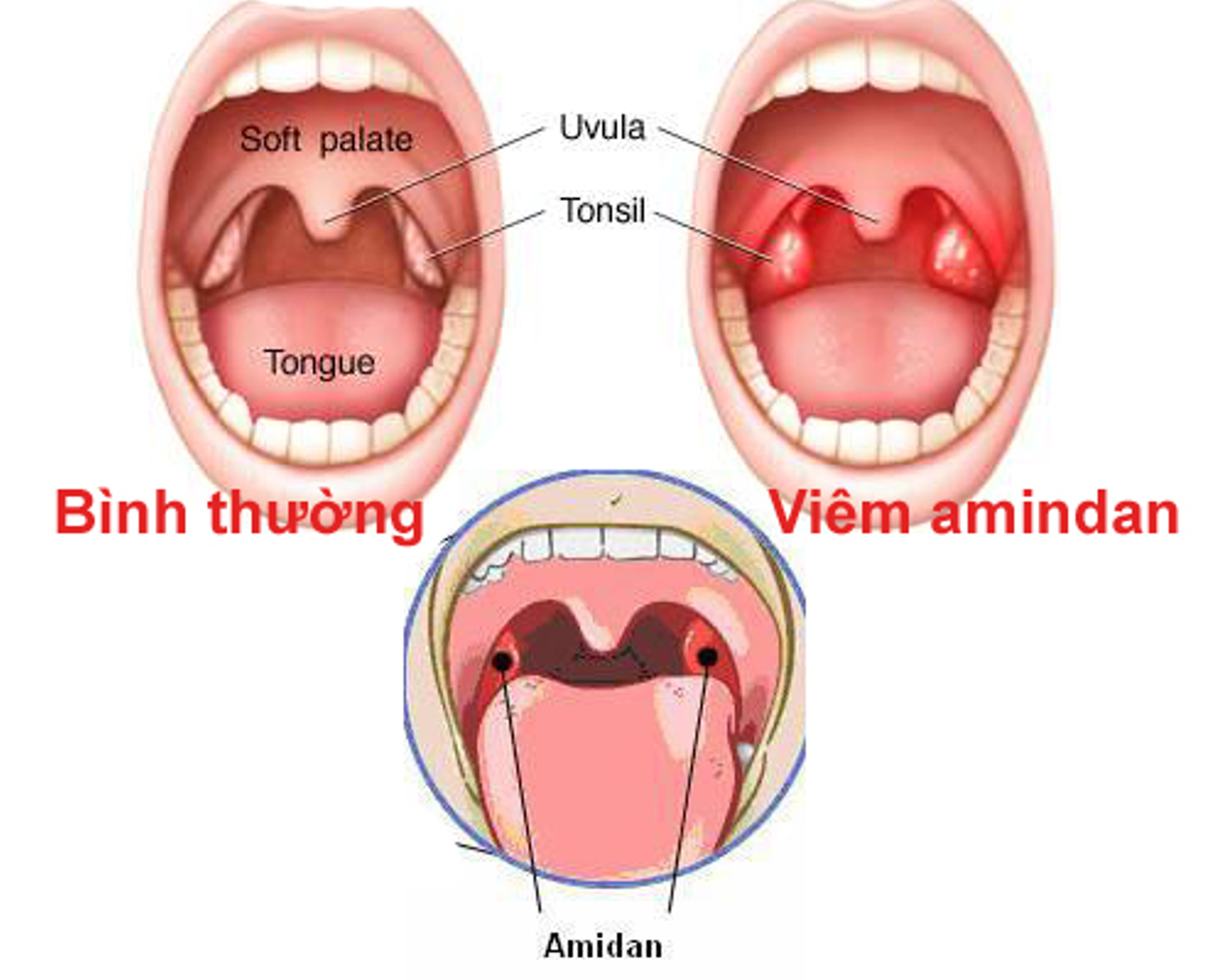 Đau họng khó nuốt nước bọt do viêm amidan