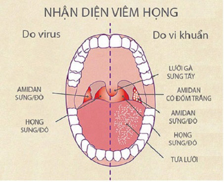 Đau họng khó nuốt nước bọt